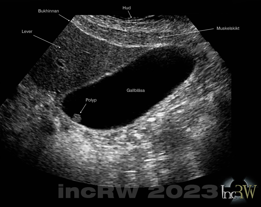 Polyp I Gallbl san Fr ga R ntgendoktorn 1998 2026 Polyp I Gallbl san Fr ga R ntgendoktorn 1998 2026
