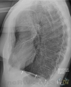 Konventionell lungröntgen avplanad lungsinus som vid KOL