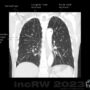 CT-thorax Kerley- injer